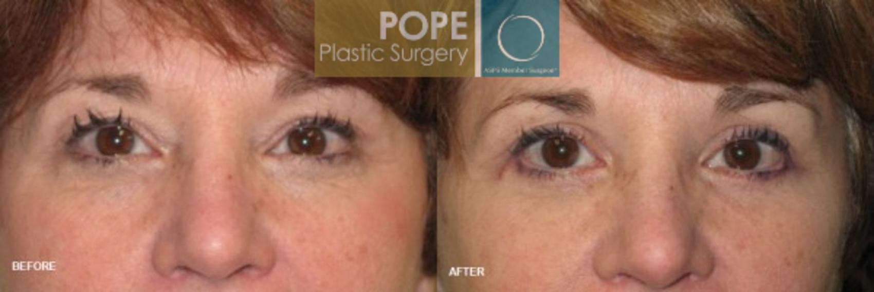 Before & After Eyelid Surgery Case 139 View #1 View in Orlando, FL