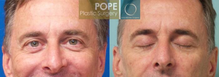 Before & After Eyelid Surgery Case 140 View #1 View in Orlando, FL