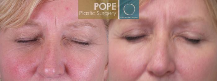Before & After Eyelid Surgery Case 141 View #1 View in Orlando, FL