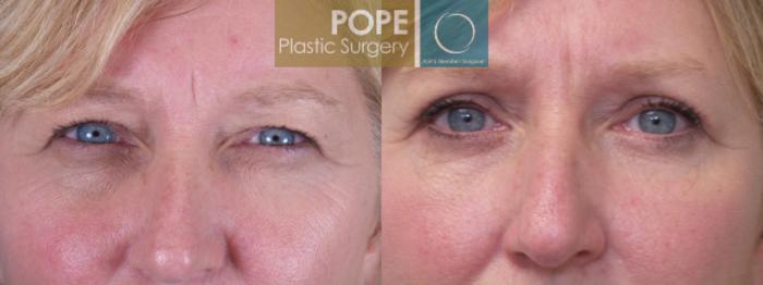 Before & After Eyelid Surgery Case 141 View #2 View in Orlando, FL