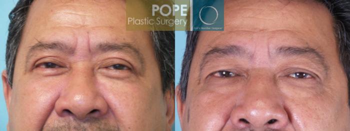 Before & After Eyelid Surgery Case 142 View #1 View in Orlando, FL