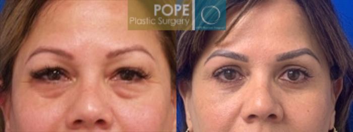 Before & After Eyelid Surgery Case 204 Close up View in Orlando, FL