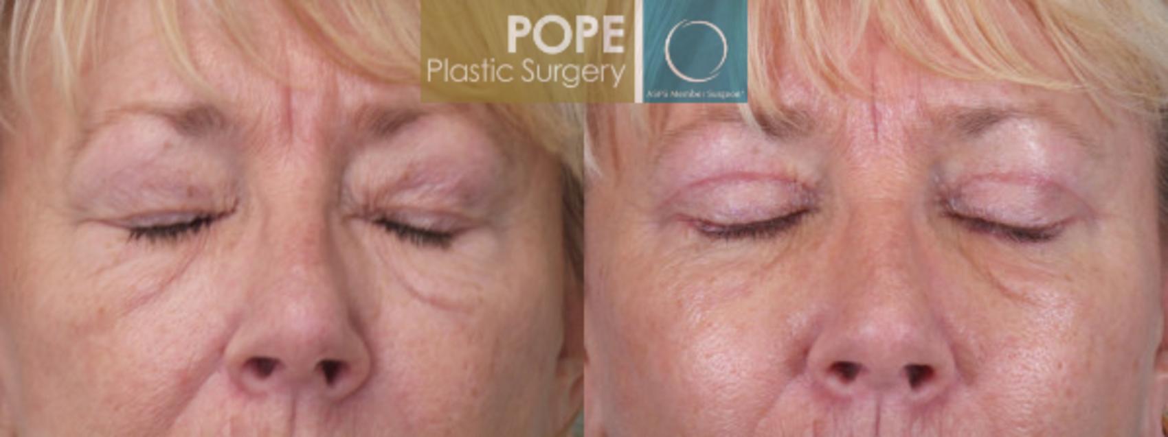 Before & After Eyelid Surgery Case 23 View #1 View in Orlando, FL