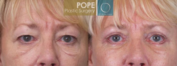 Before & After Eyelid Surgery Case 23 View #2 View in Orlando, FL