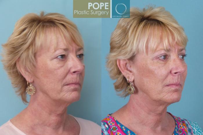 Before & After Eyelid Surgery Case 23 View #3 View in Orlando, FL