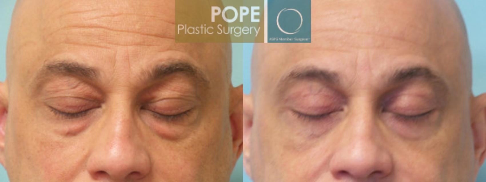Before & After Facial Procedures for Men Case 24 View #1 View in Orlando, FL