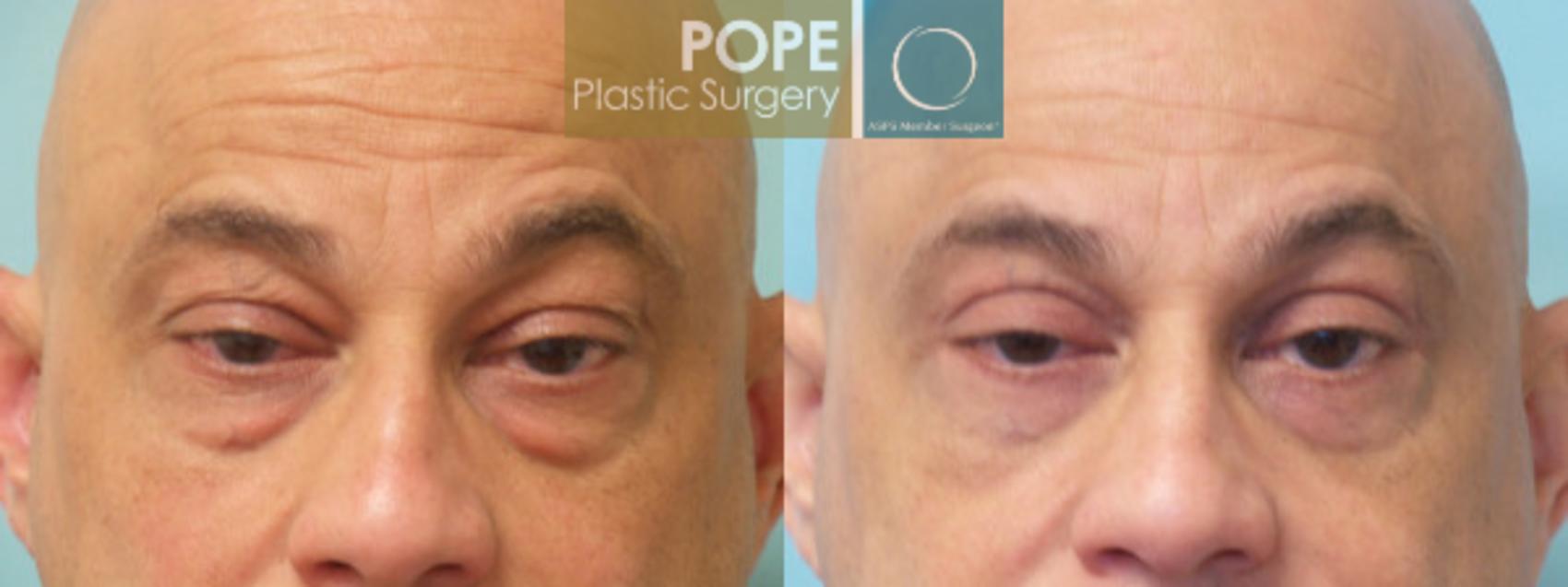 Before & After Eyelid Surgery Case 24 View #2 View in Orlando, FL