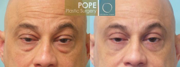 Before & After Facial Procedures for Men Case 24 View #2 View in Orlando, FL