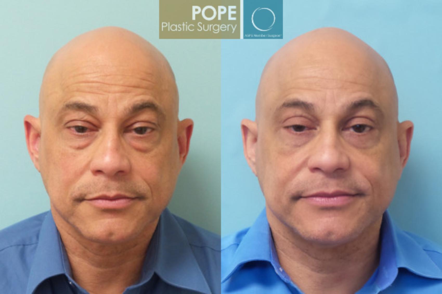 Before & After Eyelid Surgery Case 24 View #3 View in Orlando, FL