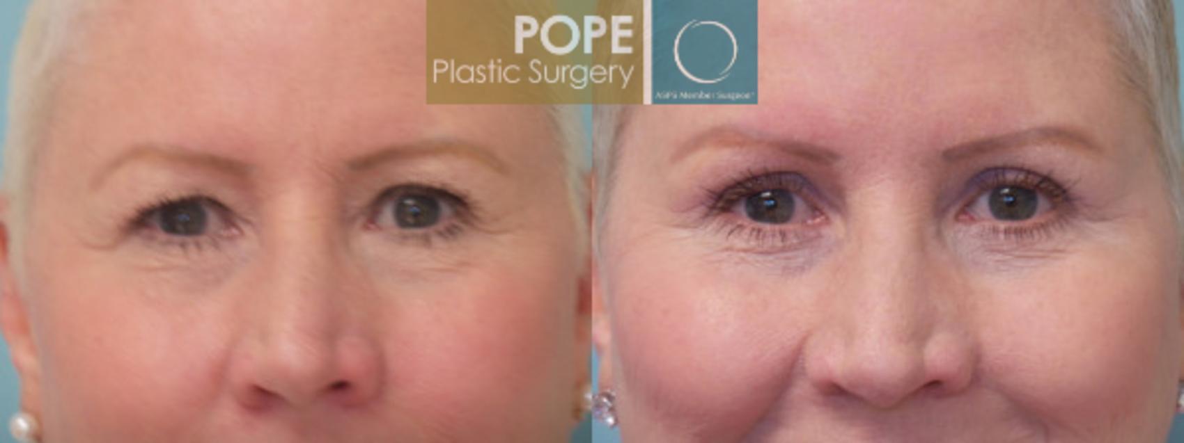 Before & After Eyelid Surgery Case 25 View #1 View in Orlando, FL