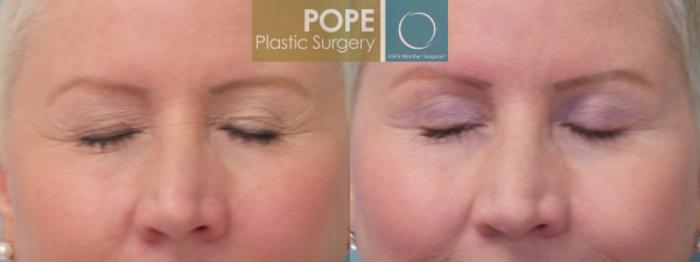 Before & After Eyelid Surgery Case 25 View #2 View in Orlando, FL