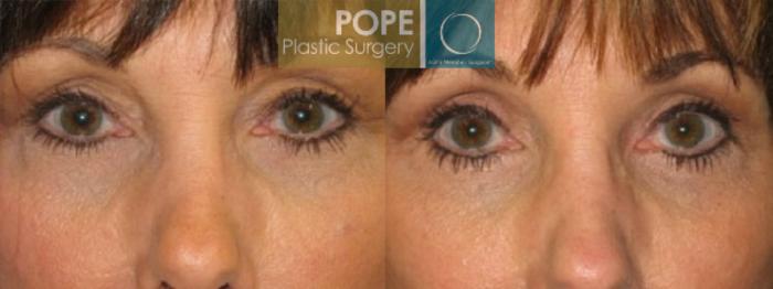 Before & After Eyelid Surgery Case 26 View #1 View in Orlando, FL