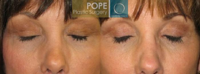 Before & After Eyelid Surgery Case 26 View #2 View in Orlando, FL
