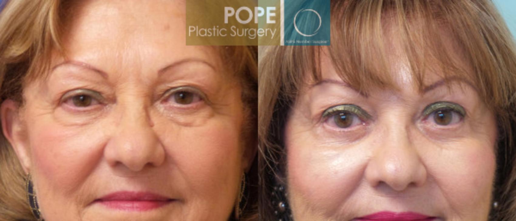 Before & After Eyelid Surgery Case 27 View #1 View in Orlando, FL