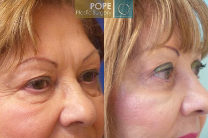 Before & After Eyelid Surgery Case 27 View #2 View in Orlando, FL