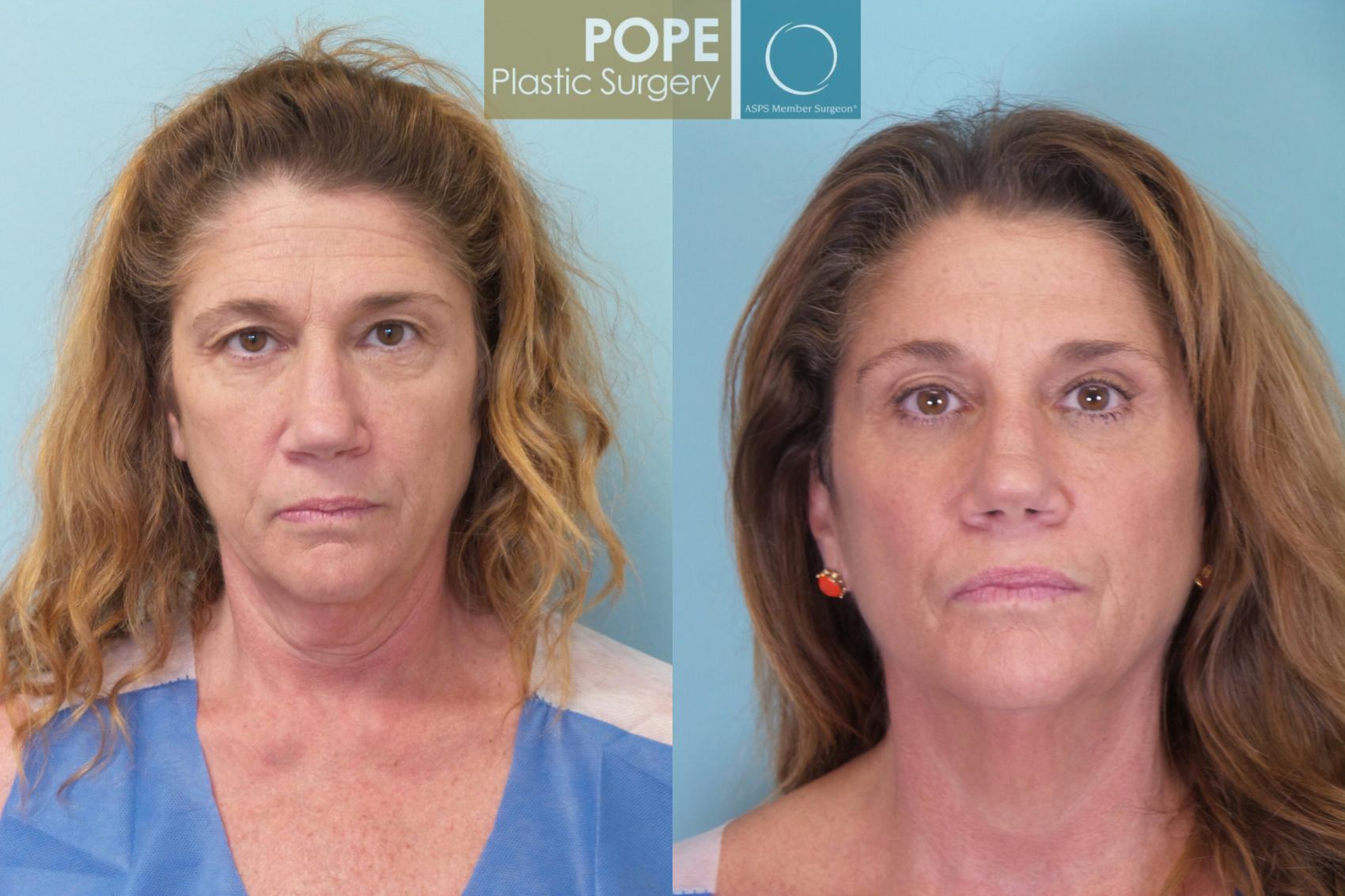Before & After Eyelid Surgery Case 76 View #1 View in Orlando, FL
