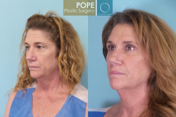 Before & After Eyelid Surgery Case 76 View #2 View in Orlando, FL