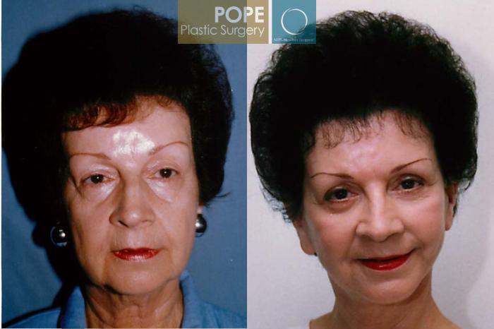 Before & After Facelift Case 103 View #1 View in Orlando, FL