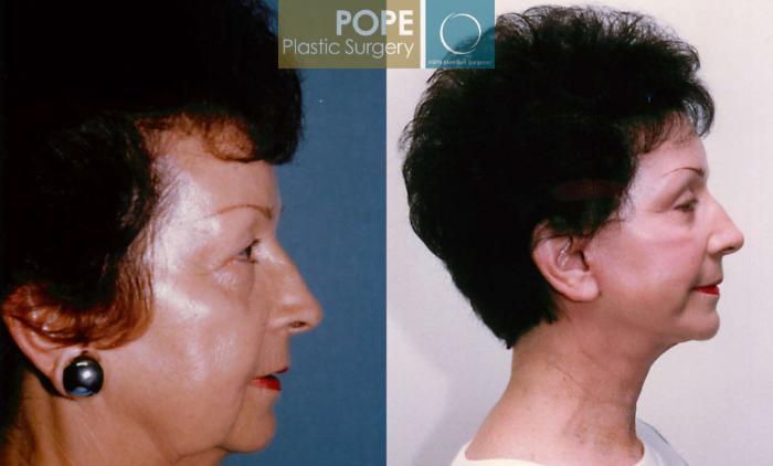 Before & After Facelift Case 103 View #2 View in Orlando, FL