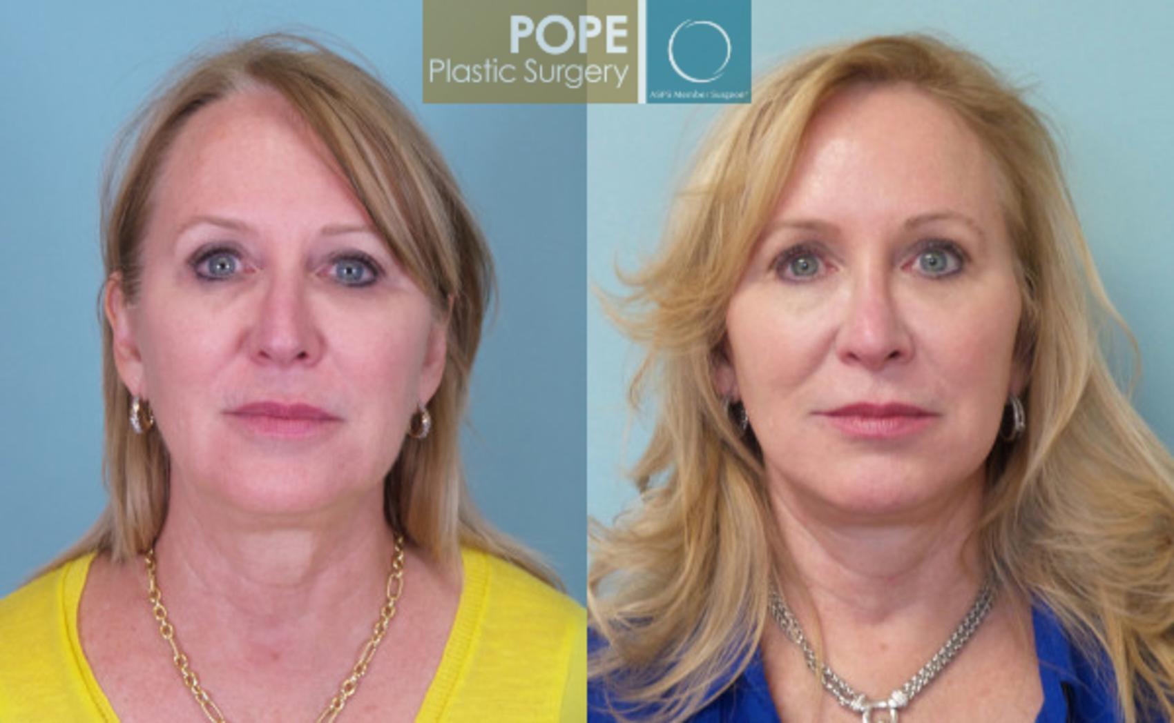Before & After Facelift Case 143 View #1 View in Orlando, FL