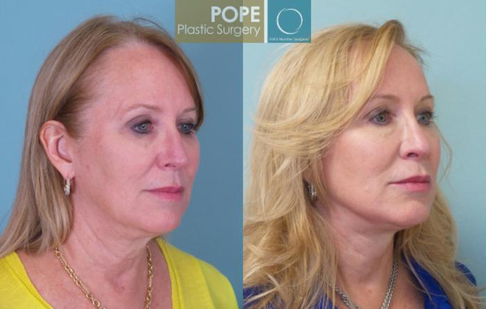 Before & After Facelift Case 143 View #2 View in Orlando, FL
