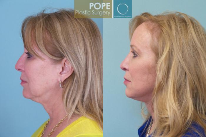 Before & After Facelift Case 143 View #3 View in Orlando, FL