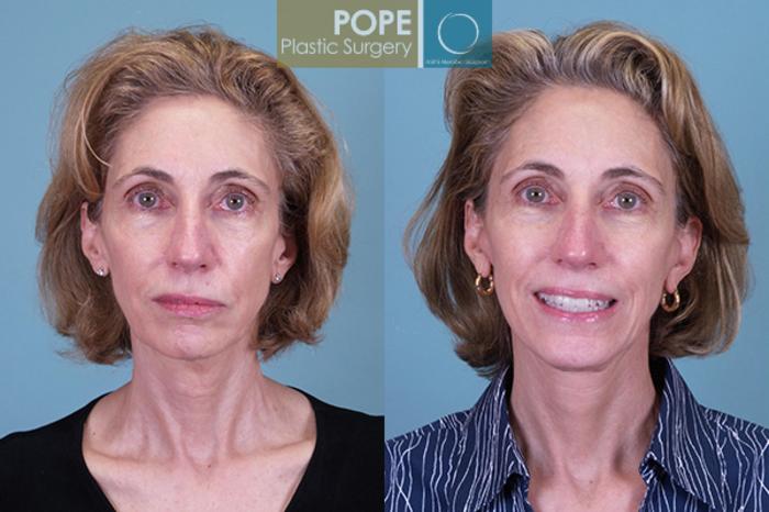 Before & After Facelift Case 144 View #1 View in Orlando, FL