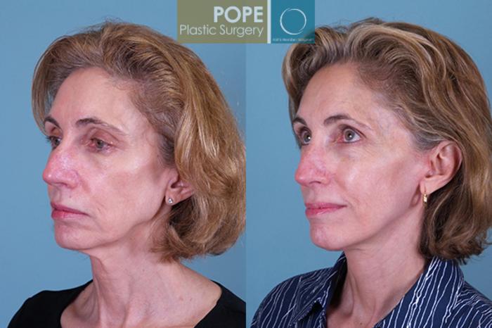 Before & After Facelift Case 144 View #2 View in Orlando, FL