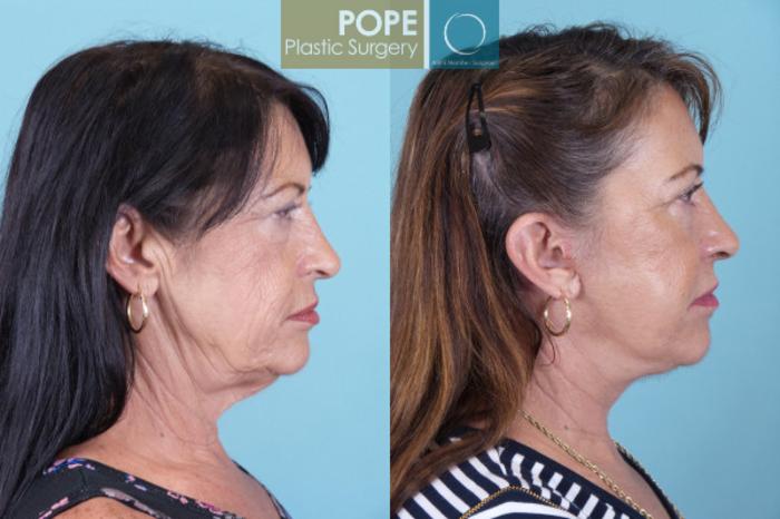 Before & After Facelift Case 19 View #2 View in Orlando, FL