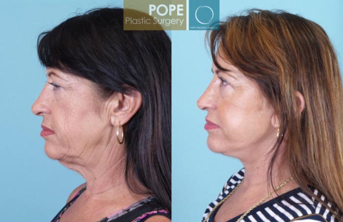 Before & After Facelift Case 19 View #3 View in Orlando, FL