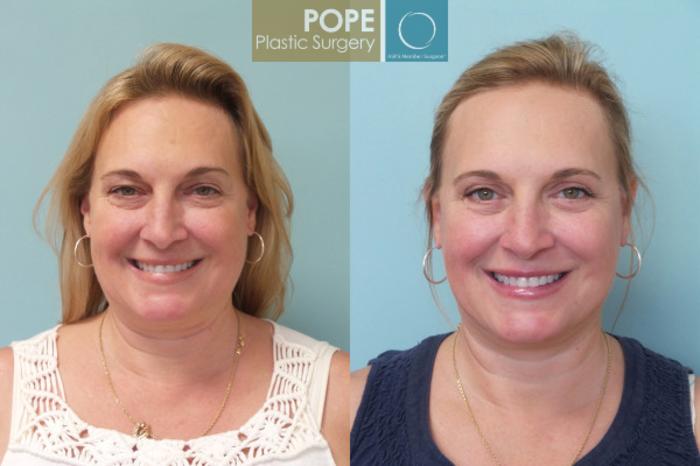Before & After Facelift Case 20 View #1 View in Orlando, FL