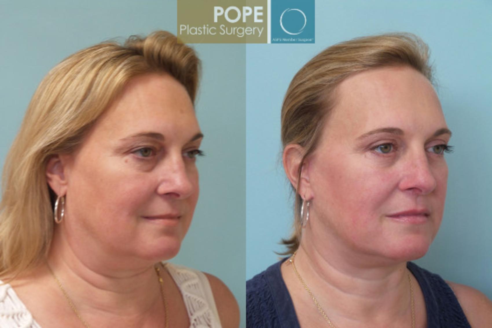 Before & After Facelift Case 20 View #2 View in Orlando, FL
