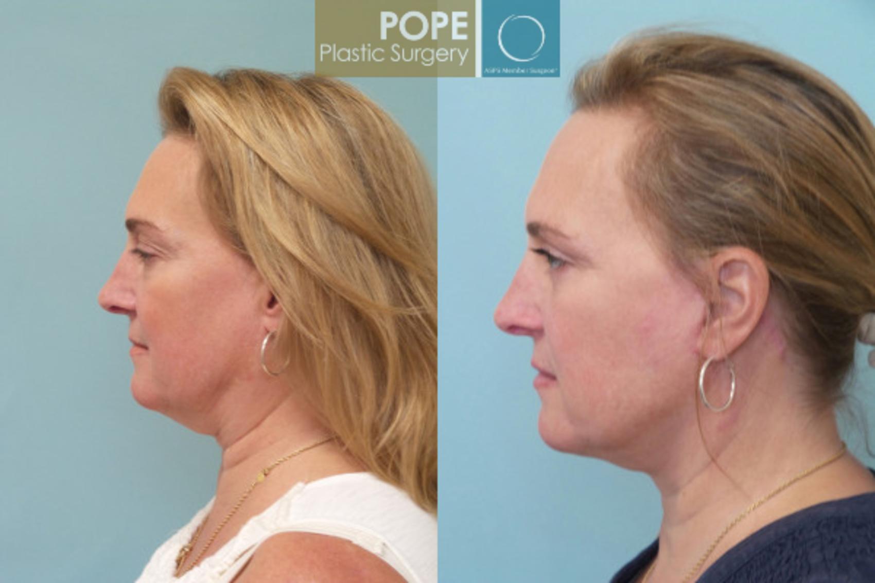 Before & After Facelift Case 20 View #3 View in Orlando, FL