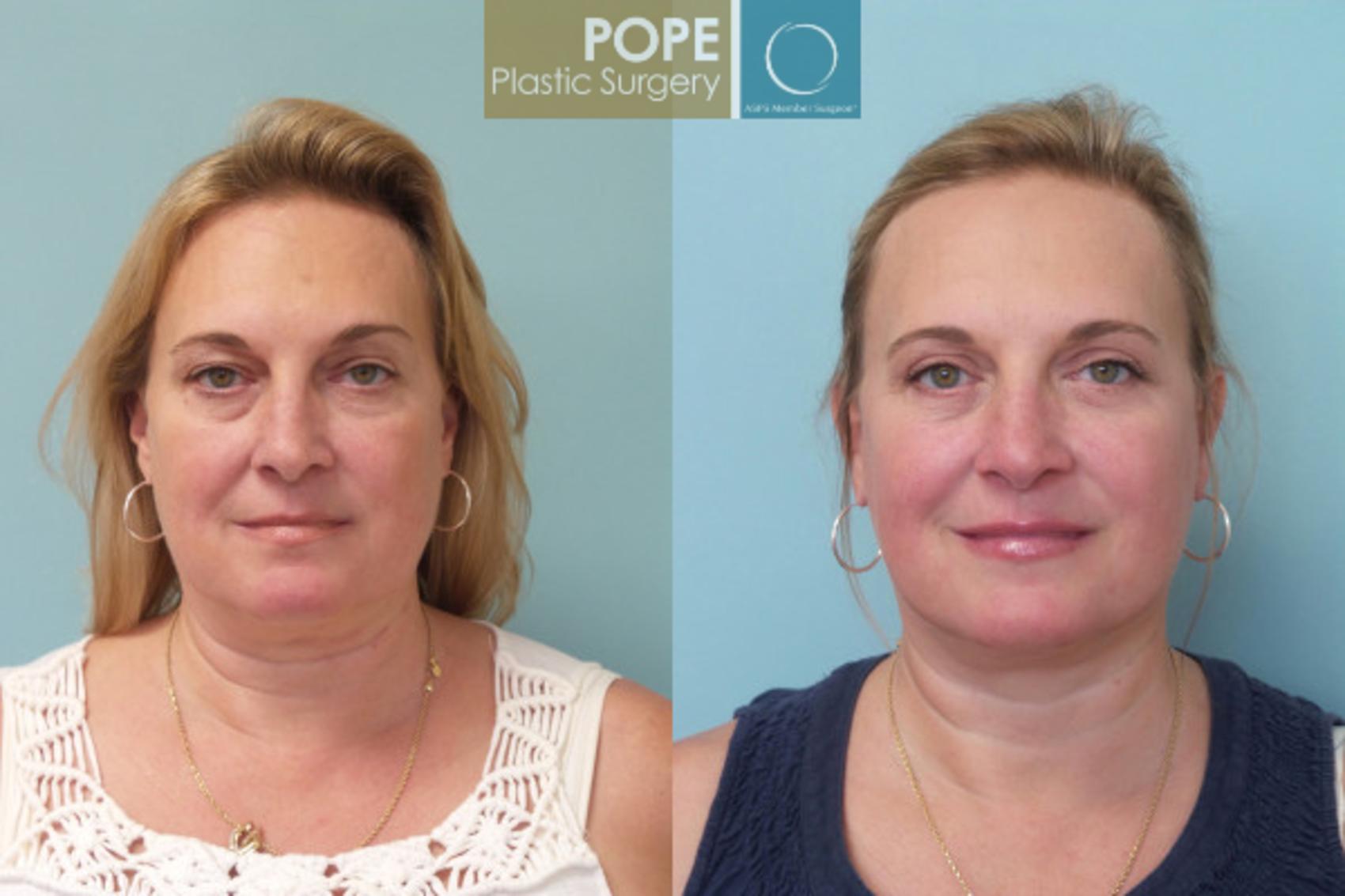 Before & After Facelift Case 20 View #4 View in Orlando, FL