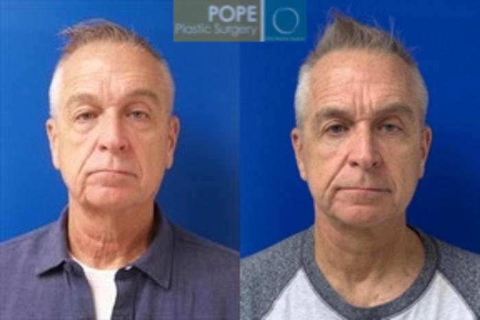63-year-old man who had facelift and upper & lower eyelid lift.