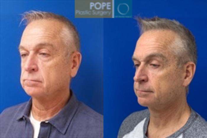 63-year-old man had upper & lower blepharoplasty and a facelift.