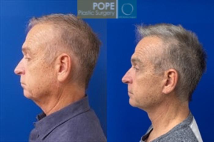 63-year-old man had upper & lower blepharoplasty and a facelift.