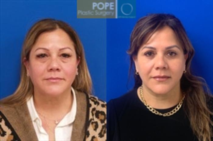 Facelift and upper and lower blepharoplasty