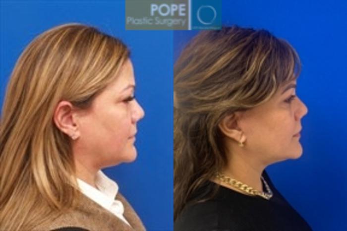 Before & After Facelift Case 203 Left Side View in Orlando, FL