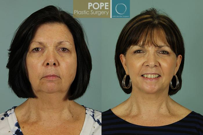 Before & After Facelift Case 22 View #1 View in Orlando, FL