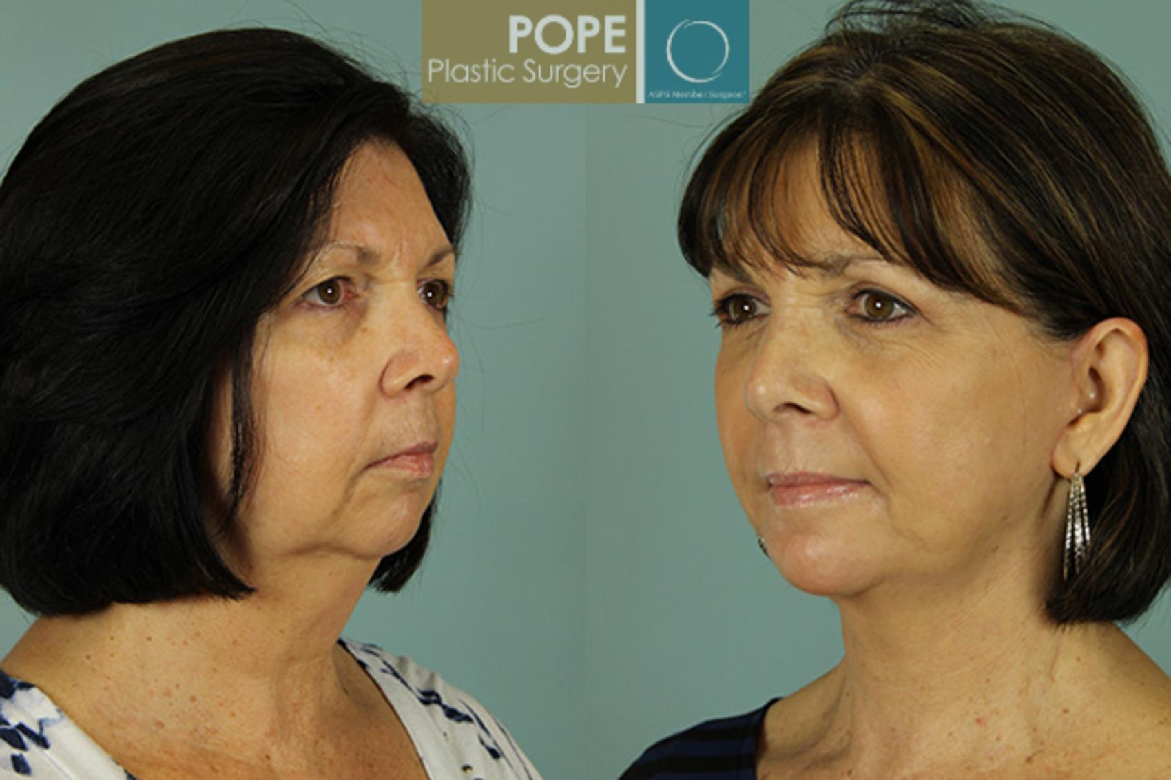 Before & After Facelift Case 22 View #2 View in Orlando, FL