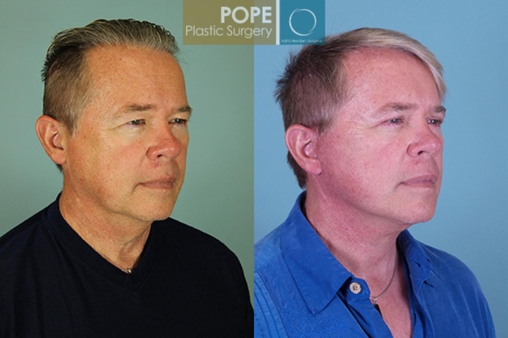 Before & After Facelift Case 69 View #2 View in Orlando, FL