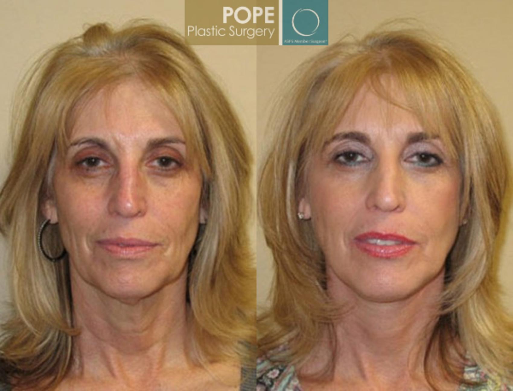 Before & After Facelift Case 70 View #1 View in Orlando, FL