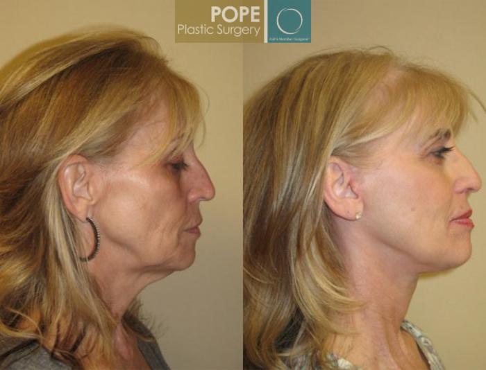 Before & After Facelift Case 70 View #2 View in Orlando, FL