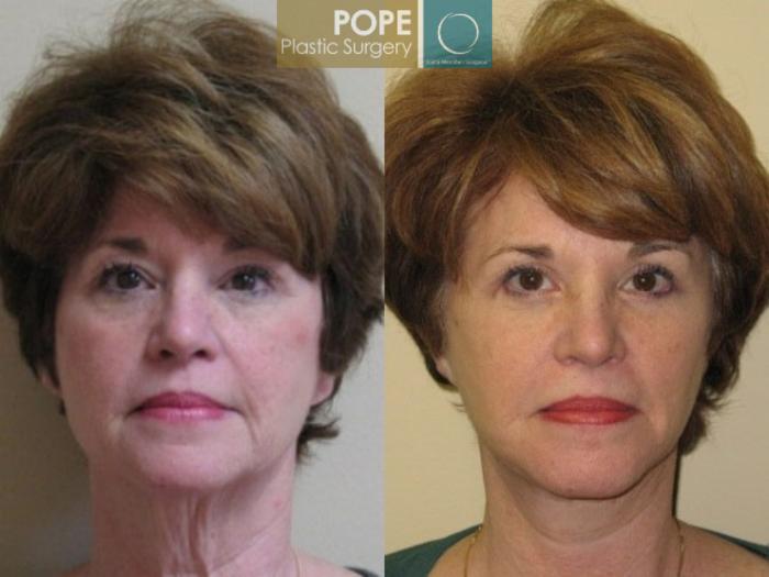 Before & After Facelift Case 71 View #1 View in Orlando, FL