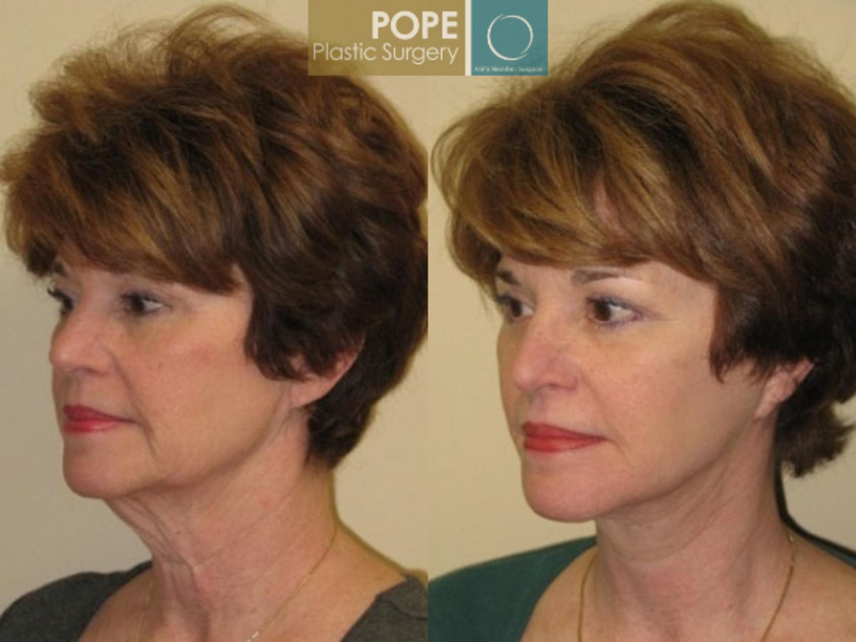 Before & After Facelift Case 71 View #2 View in Orlando, FL