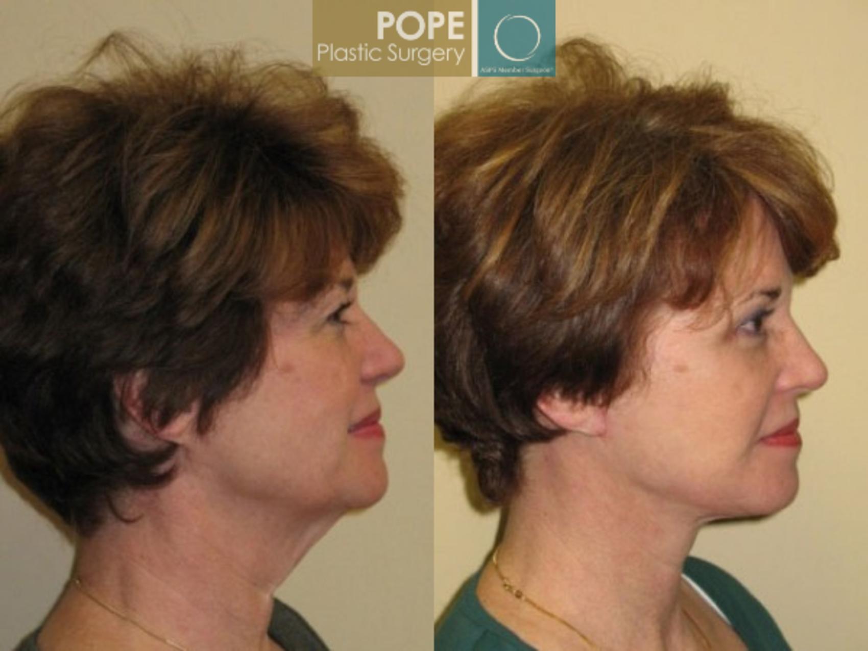 Before & After Facelift Case 71 View #3 View in Orlando, FL