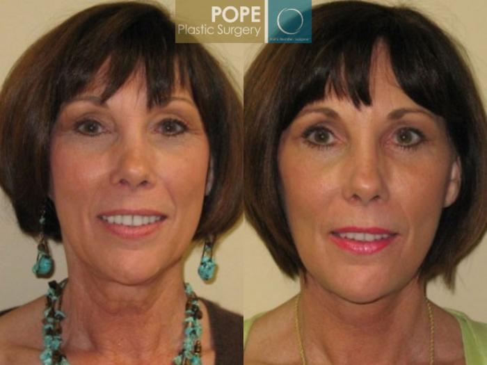 Before & After Facelift Case 72 View #1 View in Orlando, FL