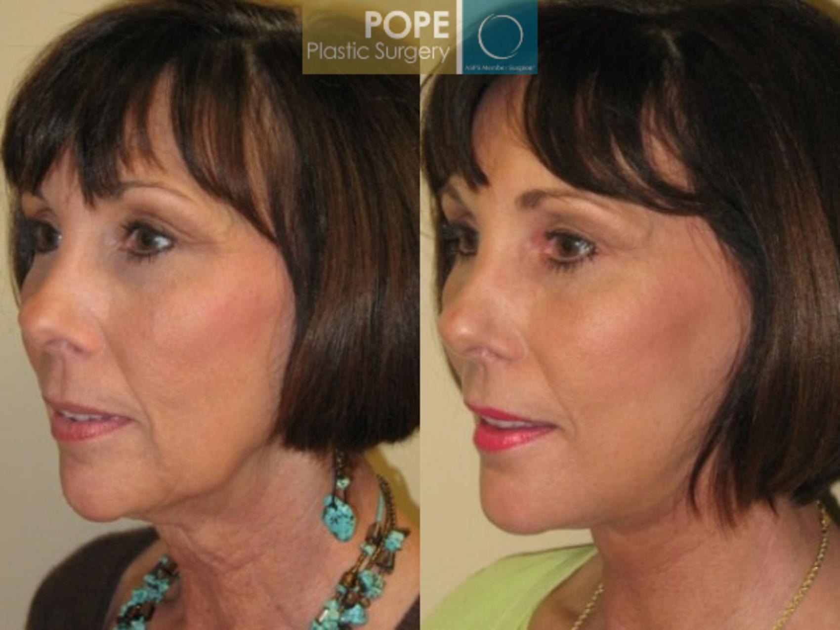 Before & After Facelift Case 72 View #2 View in Orlando, FL