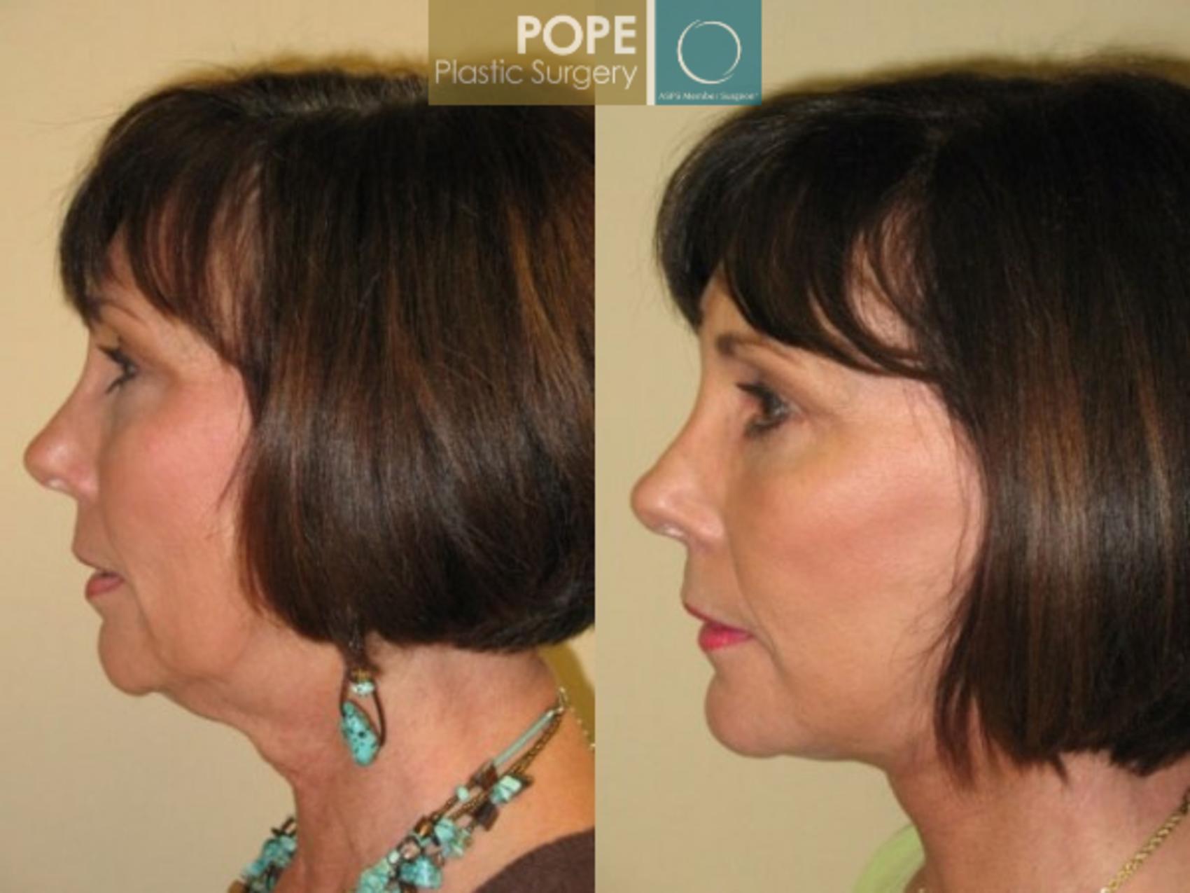 Before & After Facelift Case 72 View #3 View in Orlando, FL